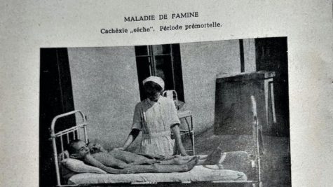 The book includes haunting photos from inside the ghetto, along with its record of the medical effects of starvation.
Maladie de Famine, American Joint Distribution Committee